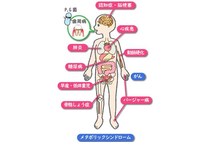 歯と病気の関連